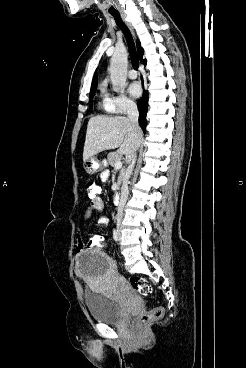 Carcinoma of uterine cervix (Radiopaedia 85861-101700 D 38).jpg