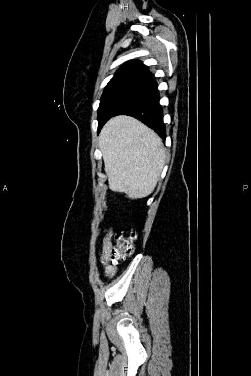 Carcinoma of uterine cervix (Radiopaedia 85861-101700 D 7).jpg