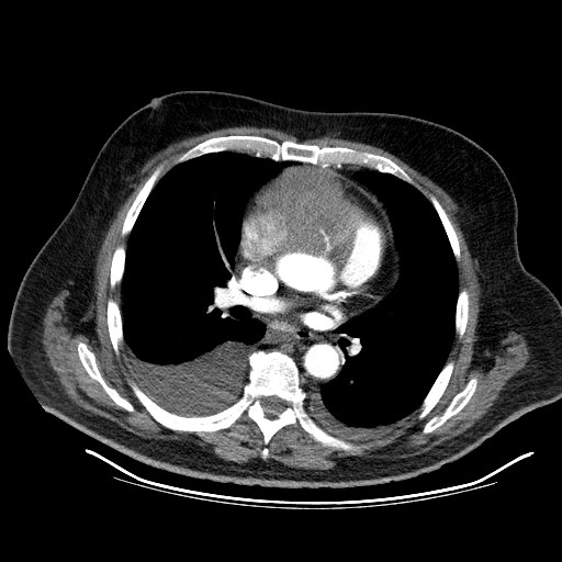 File:Cardiac lymphoma (Radiopaedia 38690-40836 Axial C+ CTPA 9).jpg