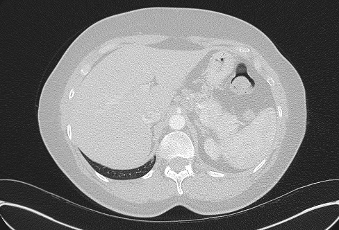 File:Cardiac sarcoidosis (Radiopaedia 74548-85534 Axial lung window 90).jpg