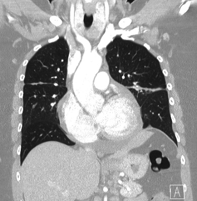 Cardiac sarcoidosis (Radiopaedia 74548-85534 Coronal lung window 27).jpg