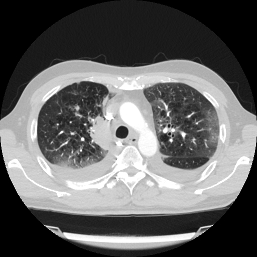 Cardiac tamponade (Radiopaedia 78607-91368 Axial lung window 22).jpg
