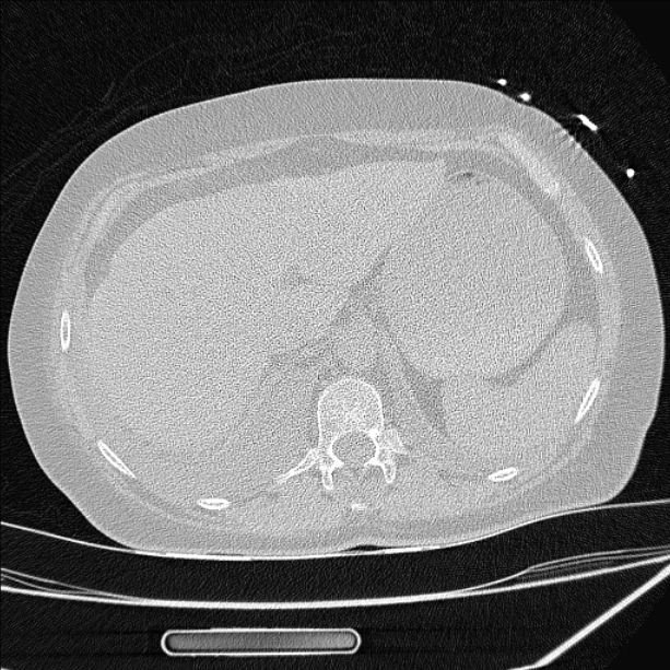Cardiogenic pulmonary edema (Radiopaedia 29213-29609 Axial lung window 102).jpg