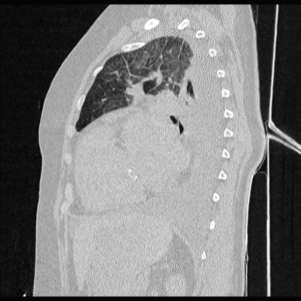 Cardiogenic pulmonary edema (Radiopaedia 29213-29609 Sagittal lung window 63).jpg