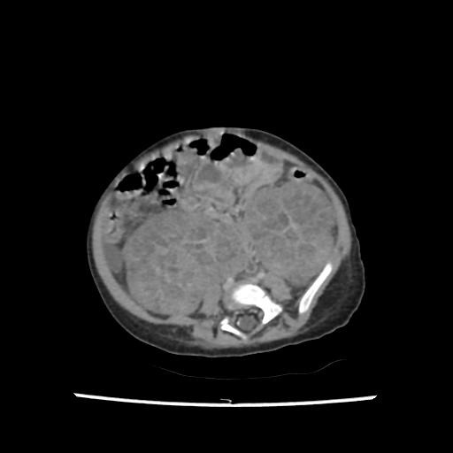 Caroli disease with autosomal recessive polycystic kidney disease (ARPKD) (Radiopaedia 89651-106703 B 152).jpg