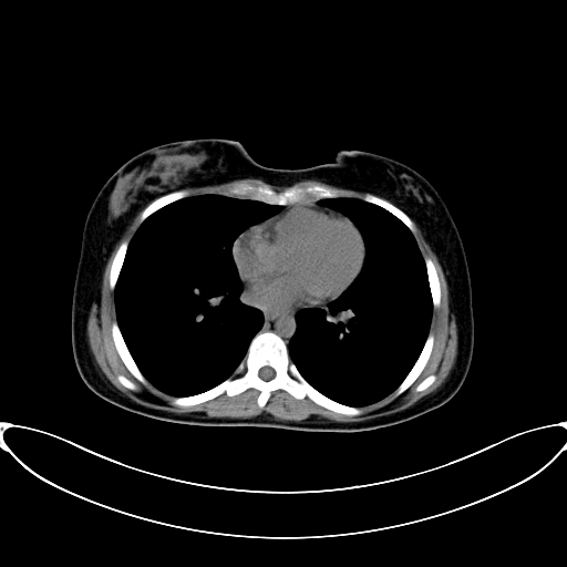 Caroli disease with medullary sponge kidney (Radiopaedia 82622-96804 Axial non-contrast 1).jpg