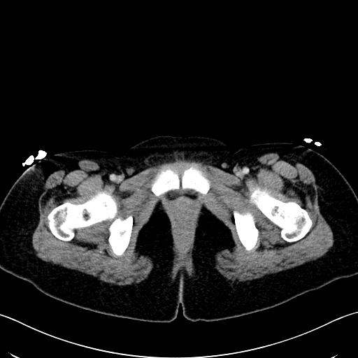 File:Caroli disease with medullary sponge kidney (Radiopaedia 82622-96804 C 78).jpg