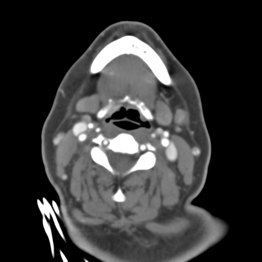 Carotico ophthalmic aneurysm (Radiopaedia 42916-46148 A 68).png