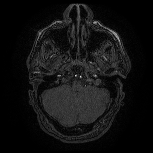 Carotid arterial dissection with acute cerebral infarction (Radiopaedia 26636-26784 MRA 144).jpg