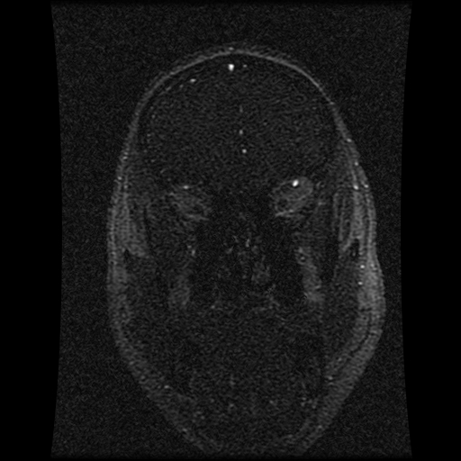 Carotid arterial dissection with acute cerebral infarction (Radiopaedia 26636-26784 MRV 126).jpg
