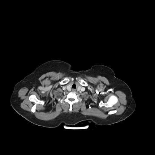 File:Carotid body tumor (Radiopaedia 21021-20948 B 22).jpg