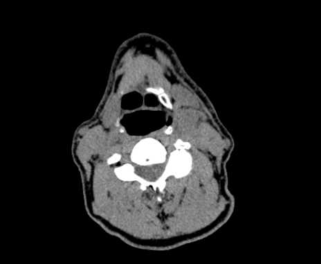 Carotid body tumor (Radiopaedia 61750-69757 Axial non-contrast 55).jpg