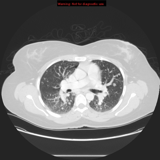 Carotid body tumor with lung metastases (Radiopaedia 9301-48390 Axial lung window 34).jpg