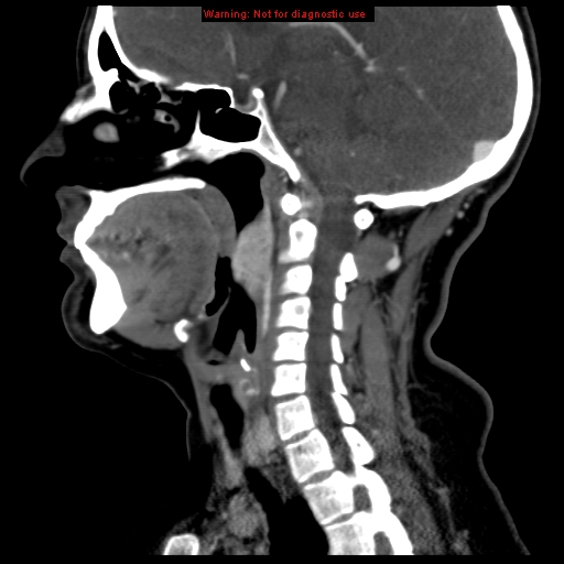File:Carotid body tumor with lung metastases (Radiopaedia 9301-9986 Sagittal C+ delayed 24).jpg