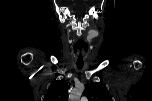 File:Carotid bulb pseudoaneurysm (Radiopaedia 57670-64616 D 25).jpg
