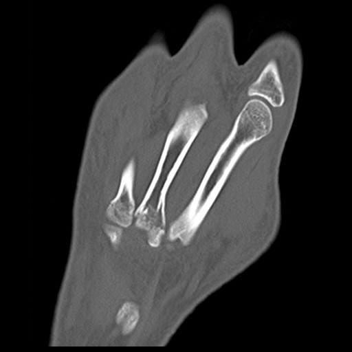 File:Carpo-metacarpal fracture-dislocations with hamatum split fracture (Radiopaedia 18482-18343 Coronal bone window 5).jpg