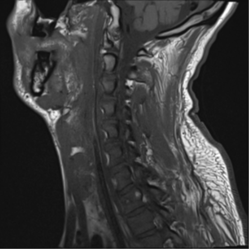 File:Cavernoma of cervical cord (Radiopaedia 50838-56347 Sagittal T1 5).png