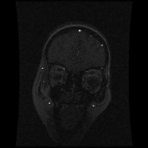 Cavernoma with developmental venous anomaly (Radiopaedia 22470-22507 MRV 105).jpg