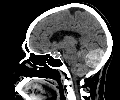 Cavernous hemangioma of the cerebellar falx (Radiopaedia 73025-83723 B 149).jpg