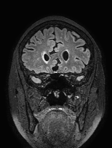 Cavernous hemangioma of the cerebellar falx (Radiopaedia 73025-83724 Coronal FLAIR 96).jpg