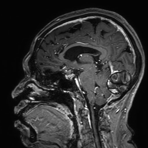 Cavernous hemangioma of the cerebellar falx (Radiopaedia 73025-83724 Sagittal T1 C+ 113).jpg