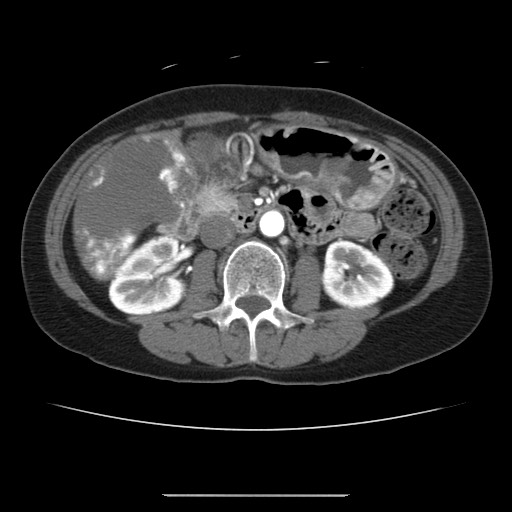 File:Cavernous hepatic hemangioma (Radiopaedia 75441-86667 A 53).jpg