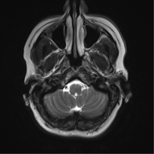 File:Cavernous malformation (cavernous angioma or cavernoma) (Radiopaedia 36675-38237 Axial T2 2).png