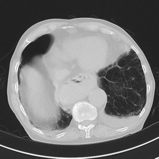 Cavitating pneumonia - lingular segments (Radiopaedia 34386-35678 Axial lung window 48).png