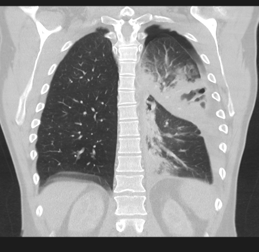 Cavitating pneumonia complicated by pneumothorax (Radiopaedia 48149-52994 Coronal lung window 42).png