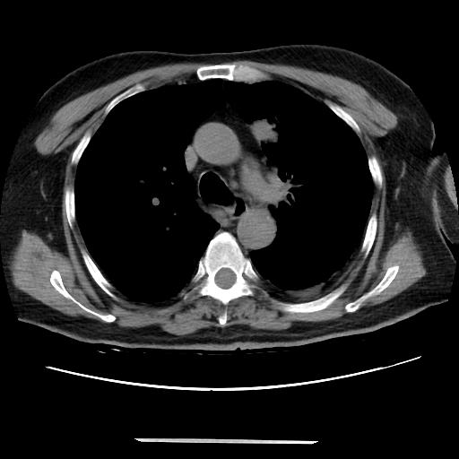 Cavitating pulmonary metastases (Radiopaedia 89545-106544 Axial non-contrast 21).jpg
