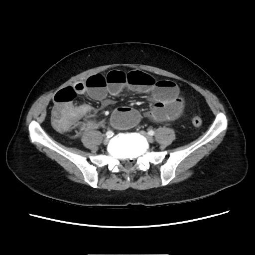 Cecal adenocarcinoma (Radiopaedia 75909-87331 A 61).jpg