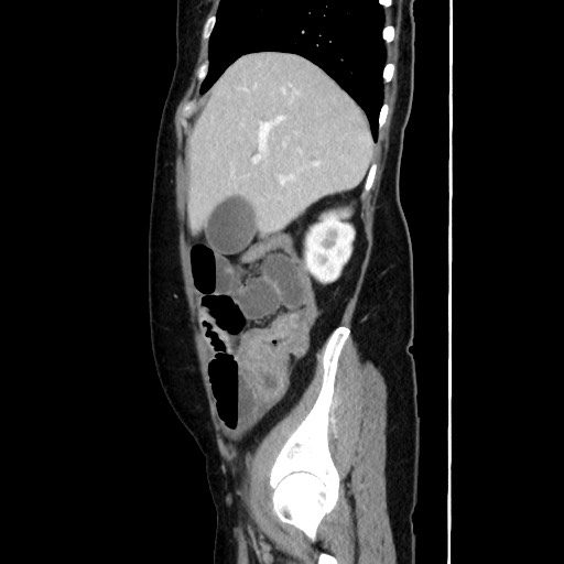 Cecal adenocarcinoma (Radiopaedia 75909-87331 C 21).jpg