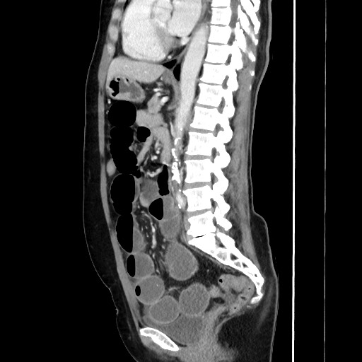 Cecal adenocarcinoma (Radiopaedia 75909-87331 C 41).jpg