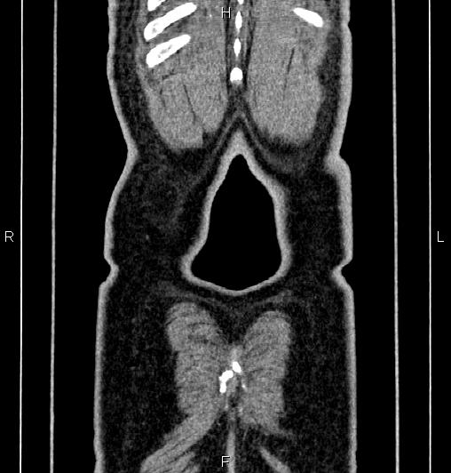Cecal adenocarcinoma (Radiopaedia 85324-100916 D 68).jpg