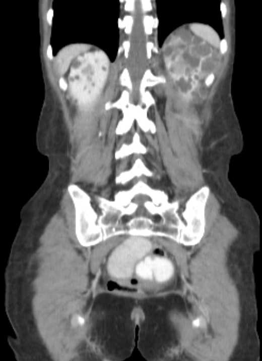 Cecal volvulus with pneumatosis coli (Radiopaedia 68572-78178 B 12).jpg
