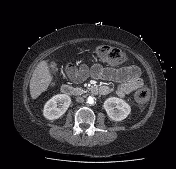 Celiac artery severe stenosis and dissection (Radiopaedia 44128-47842 B 43).jpg