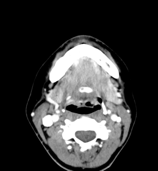 File:Cemento-ossifying fibroma (Radiopaedia 46243-50643 Axial C+ delayed 44).png