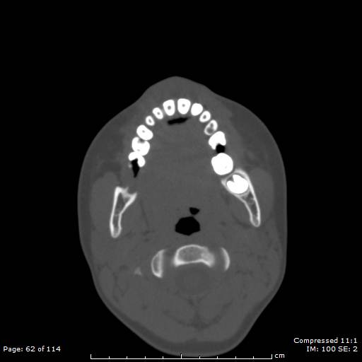File:Central giant cell granuloma (Radiopaedia 45612-49754 Axial bone window 31).jpg