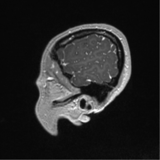 Central neurocytoma (Radiopaedia 37664-39557 Sagittal T1 C+ 84).png