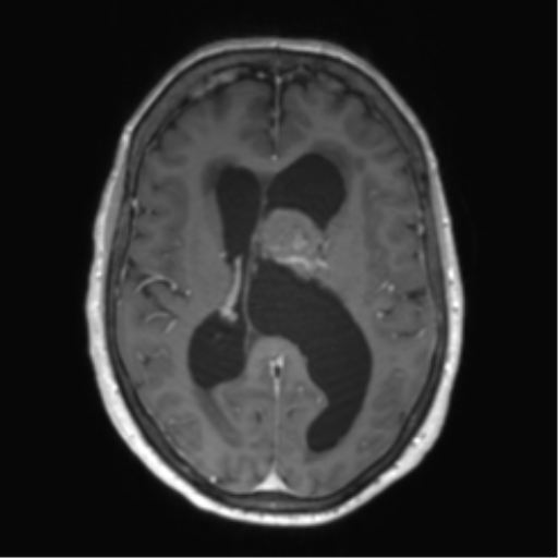 Central neurocytoma (Radiopaedia 65317-74345 Axial T1 C+ 31).png