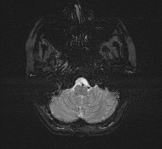 Central neurocytoma (Radiopaedia 70263-80336 Axial SWI 5).jpg