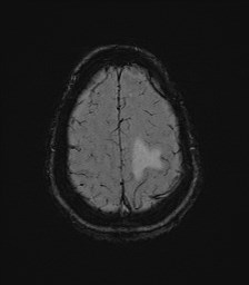 Central neurocytoma (Radiopaedia 84497-99872 Axial SWI 60).jpg