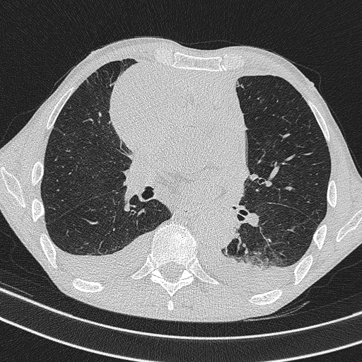 Central venous catheter tip extravasation (Radiopaedia 82828-97113 Axial lung window 46).jpg