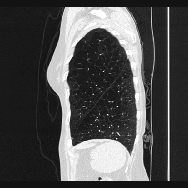 Centrilobular pulmonary emphysema (Radiopaedia 24495-24789 Sagittal lung window 74).jpg