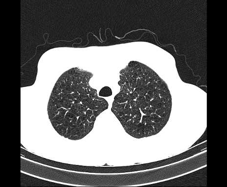 Centrilobular pulmonary emphysema (Radiopaedia 62468-70718 Axial lung window 14).jpg