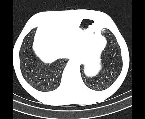 Centrilobular pulmonary emphysema (Radiopaedia 62468-70718 Axial lung window 67).jpg