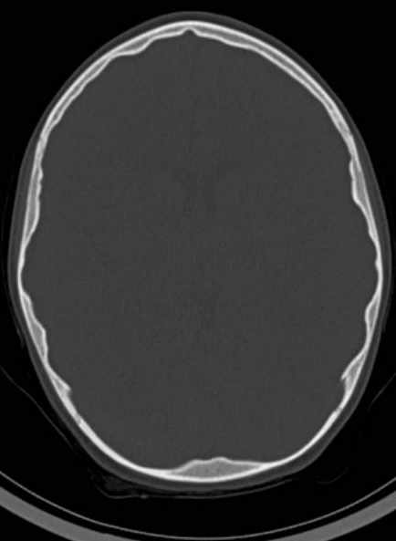 Cerebellar abscess (Radiopaedia 73727-84527 Axial bone window 38).jpg