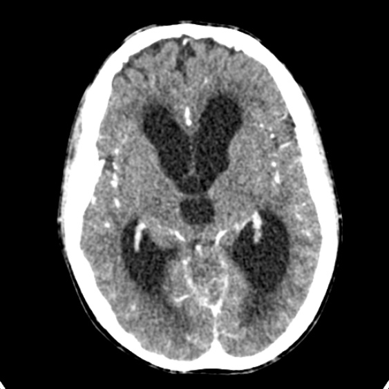 Cerebellar abscess secondary to mastoiditis (Radiopaedia 26284-26412 Axial C+ delayed 73).jpg