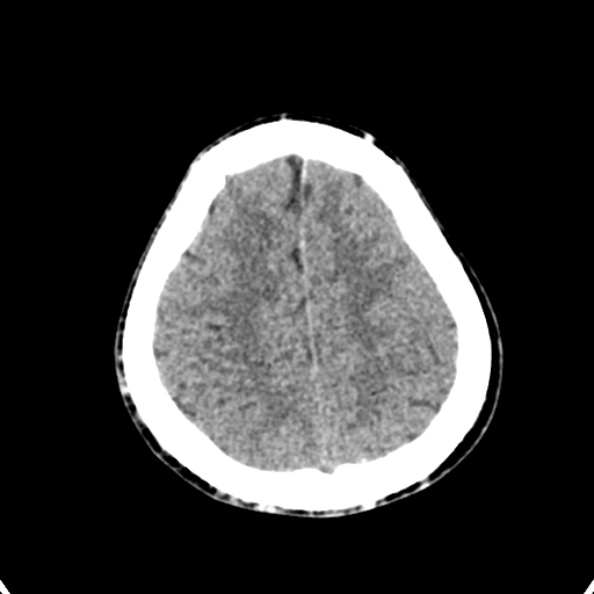 Cerebellar abscess secondary to mastoiditis (Radiopaedia 26284-26412 Axial non-contrast 132).jpg