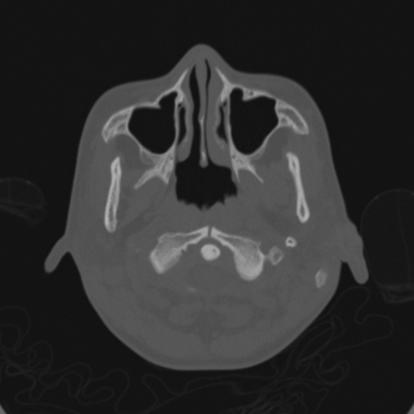 Cerebellar abscess secondary to mastoiditis (Radiopaedia 26284-26413 Axial bone window 7).jpg